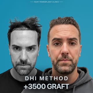 Trusting the process brings you right here 🖊️📐✨

3500+ grafts implanted using our direct hair tech