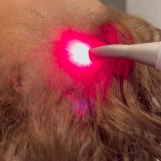 Você já ouviu falar dos benefícios do laser para a saúde capilar?

A LLLT (Low-Level Laser Therapy),