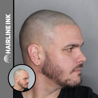 Hairline restored after just 2 sessions of Scalp Micropigmentation 🤟🏽
.
.
.
.
.
.
.
#ConfidentlyBa