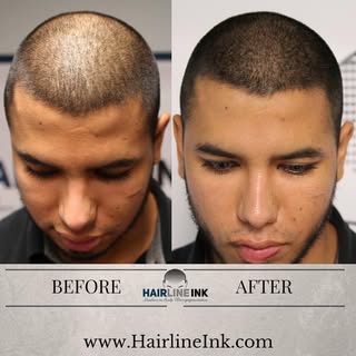 Amazing results from #scalpmicropigmentation treatment by #hairlineink! Here, we added density to gi
