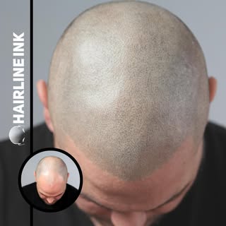 A view from the top! Our client Mark received two sessions of Scalp Micropigmentation providing him 
