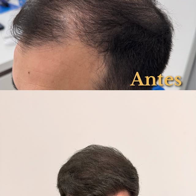 ✨ Un año después, el cambio es total

Este antes y después muestra mucho más que una cirugía capilar