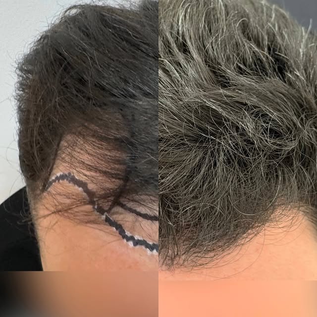 ✨ 12 meses después, la densidad habla por sí sola

Este antes y después muestra el resultado final d