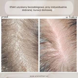 Masz dość łupieżu, ŁZS lub łuszczycy skóry głowy? 🧴 Kluczem jest dobrze dobrana, indywidualna kurac
