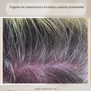 Poparzony przedziałek na słońcu to nie tylko chwilowy dyskomfort — to realne uszkodzenie skóry głowy