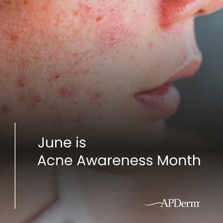 Acne can impact more than just your skin—it can affect confidence, self-esteem, and quality of life 