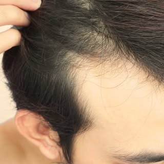 Hair loss doesn't just happen with age. Stress, hormones, genetics, nutritional deficiencies, medica
