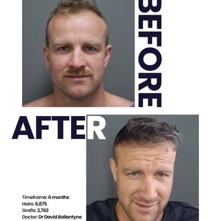 Six months into growth, and this hairline is still developing.

2,762 grafts across 6,875 hairs, pla