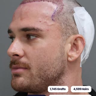 1,745 grafts. 4,599 hairs. Every one placed with a reason.

This hairline was designed around densit