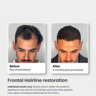 Six months post-procedure. Here’s the progress so far.

In this Melbourne case, 3,146 grafts (8,741 
