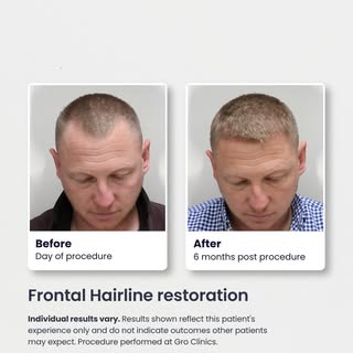 An early check-in, and this patient’s progress is already coming through in this 6 month update.

3,