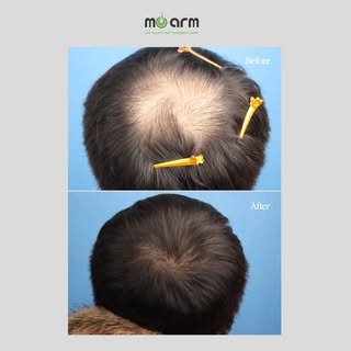 Real density, restored one graft at a time. 💪

Look closely at this transformation from Moarm Hair 