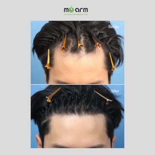 A natural hairline changes everything. 👏

This patient came to Moarm with a receding hairline and l