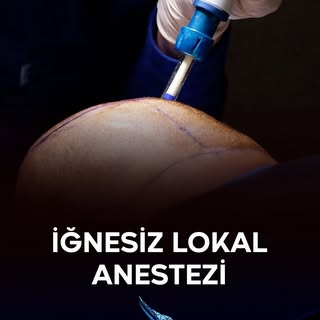 İğnesiz Lokal Anesteziyle Yeni Nesil Saç Ekimi ;

İğnesiz Lokal Anestezi Uygulaması : 
Kliniğimizde,