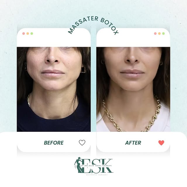A more defined and feminine jawline without surgery 💉
Masseter Botox relaxes the jaw muscles, creat