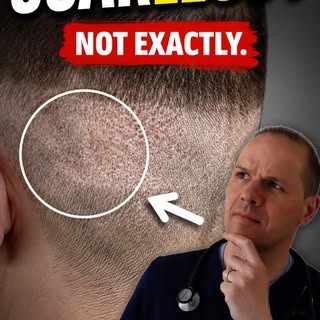 FUE is often called “scarless,” but that is not really accurate.

It usually avoids one linear FUT s