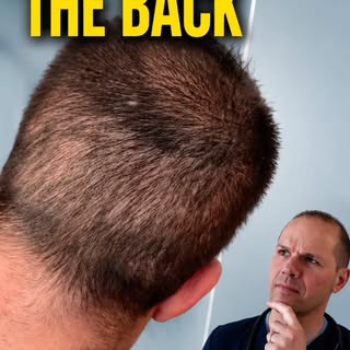 Everyone shows you the new hairline. Almost nobody shows you the back of the head.

The donor area i