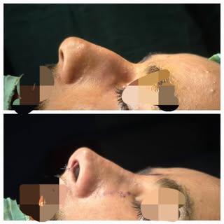 Septorhinoplasty for large hump and deviated septum. 

www.drnaumangill.com 
www.plasticsurgerypk.co