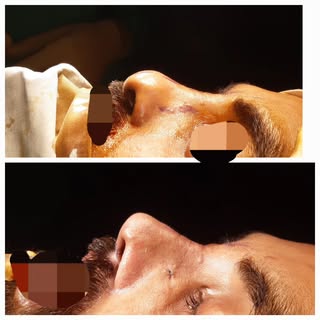 Severely depressed nose because of past infection can be very challenging. Main aim in such patients