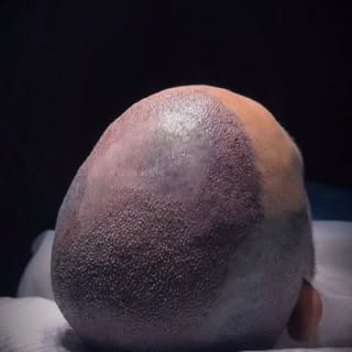✨Transplante Capilar FUE. Pós-operatório imediato.

▪️Reconstrução das entradas, corredores laterais