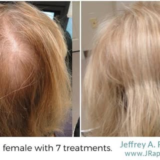 PRP results - hair restoration with platelets rich plasma in New Jersey