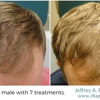 PRP hair restoration results