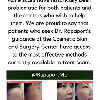 Dr Rapaport has 25 years of experience in removing acne scars with 1000s satisfied patients. Call us