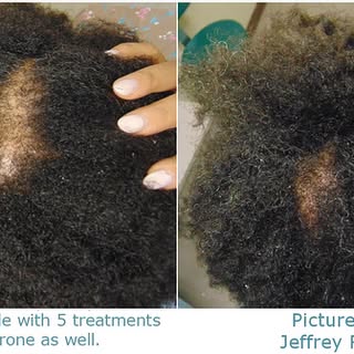 39 yr old female with 5 PRP treatments using progesterone as well. Visit JRapaportMD.com for more in