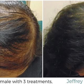 36 year old patient results with PRP #hairrestoration #prp