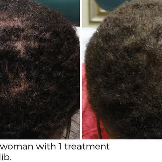 PRP for hair results in New Jersey