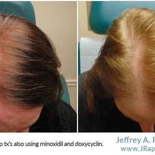 Our results are consistent! PRP is the new “botox for hair”. Grow your hair and restore thinning hai