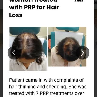 Recent patient results! #prp