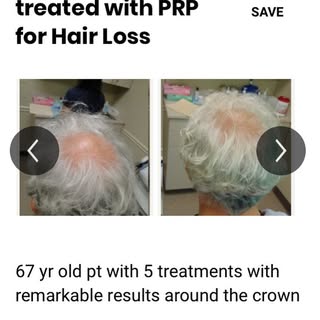 Amazing #prp results with 67yo patient! Get your #prphairrestoration done today with best #prphair #