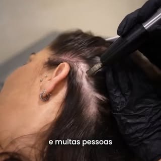 O MMP é um dos procedimentos mais indicados quando o folículo está fraco,

mas ainda tem vida.

É um