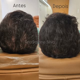 Mais um tratamento finalizado com sucesso 🚀
Cabelos mais cheios e autoestima renovada.

A calvice t