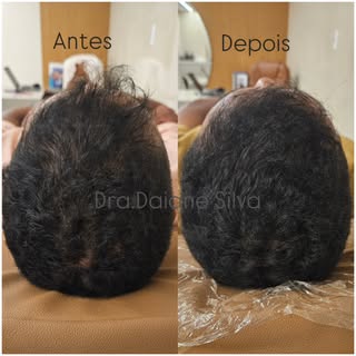Mais um paciente com volume recuperado e a calvície controlada em apenas cinco sessões. 

Realizamos