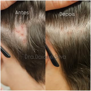 Mais um caso de sucesso 🙏🏼👏🏻

A alopecia areata é uma condição autoimune. Acontece quando o sist
