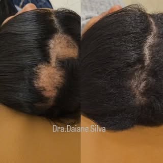 A alopecia areata vai muito além da queda de cabelo. Trata-se de uma condição que exige investigação