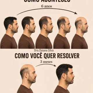 A perda capilar não acontece da noite para o dia. Ela é um processo progressivo que pode levar anos 