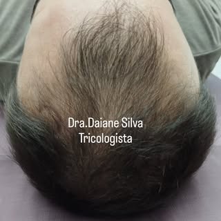 ✨️ Relembrando esse caso clínico para reversão da calvície. 

Em 2023 iniciamos um tratamento de oit