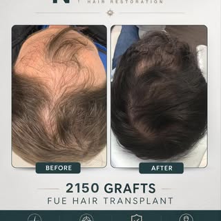 This patient underwent a 2150-graft FUE hair transplant at Northeast Hair Restoration.⁠
⁠
Hair loss 