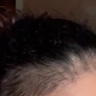 Hair transplantion to EDGES 2000 grafts (follicular units) day of procedure and 6 months later