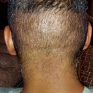 Before, and after fue ( follicular unit extraction) 1200 grafts. To front hairline and 1 year later