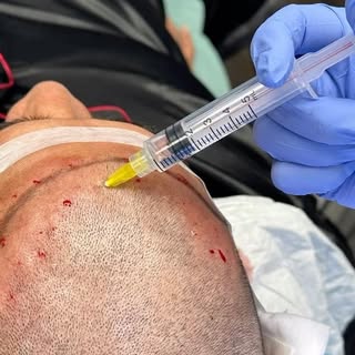 Hair Transplant + prp