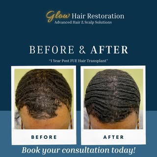 One year. One decision. Lasting results.

This before & after highlights the natural progression of 