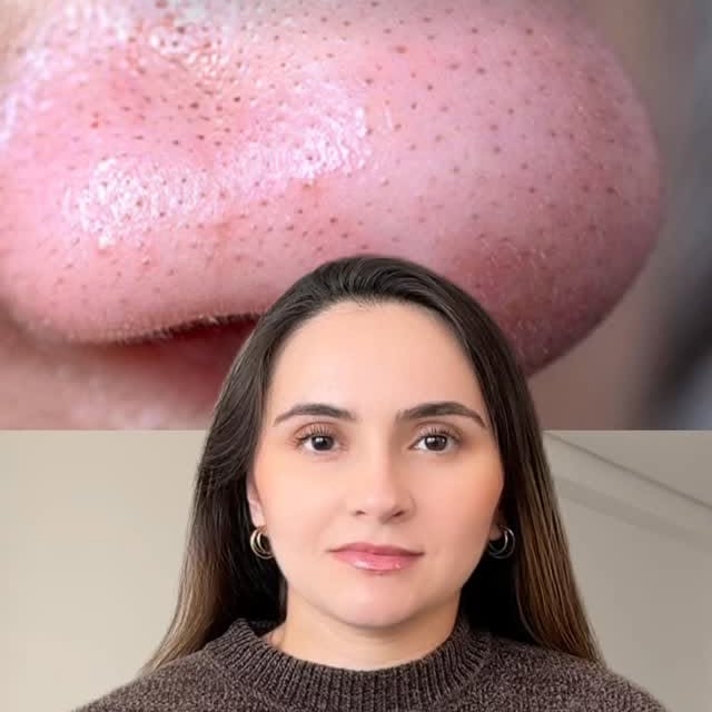 Talvez uma das maiores confusões quando o assunto é pele seja achar que todo pontinho escuro no nari