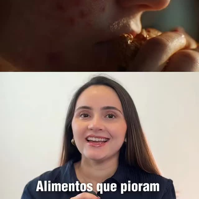 Nem toda acne está relacionada à alimentação.

Mas também não é verdade que a alimentação nunca infl