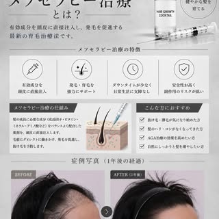 女性の患者様が多い当院ですが、男性の薄毛治療も多数ご相談いただいています。

今回ご紹介するのは、メソセラピー治療を継続された男性患者様の12ヶ月経過症例です。

治療前と比較すると、生え際の密度が向