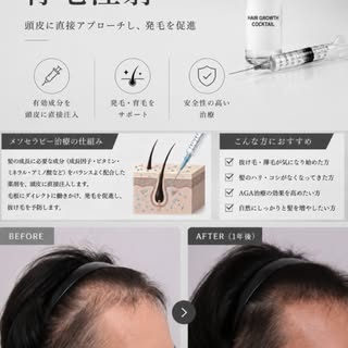 女性の患者様が多い当院ですが、男性の薄毛治療も多数ご相談いただいています。

今回ご紹介するのは、メソセラピー治療を継続された男性患者様の12ヶ月経過症例です。

治療前と比較すると、生え際の密度が向