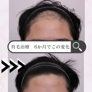 植毛手術の他にも増毛、育毛の治療の選択肢はメソセラピーや内服など、さまざまなアプローチ方法がございます✨一度ぜひご相談くださいませ。
#エイジングケア #植毛 #メソセラピー #薄毛　#フィナステリド